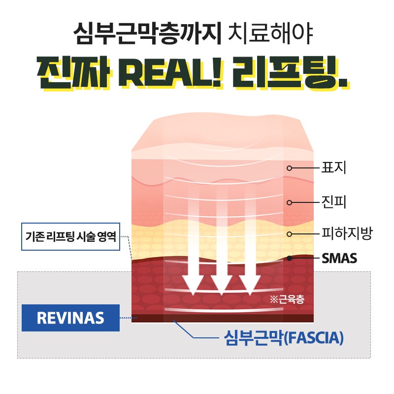 레비나스 리프팅 주목받는 이유 총정리 사진 3