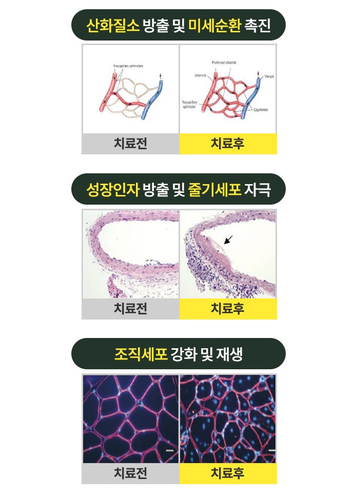 레비나스 리프팅 주목받는 이유 총정리 사진 5